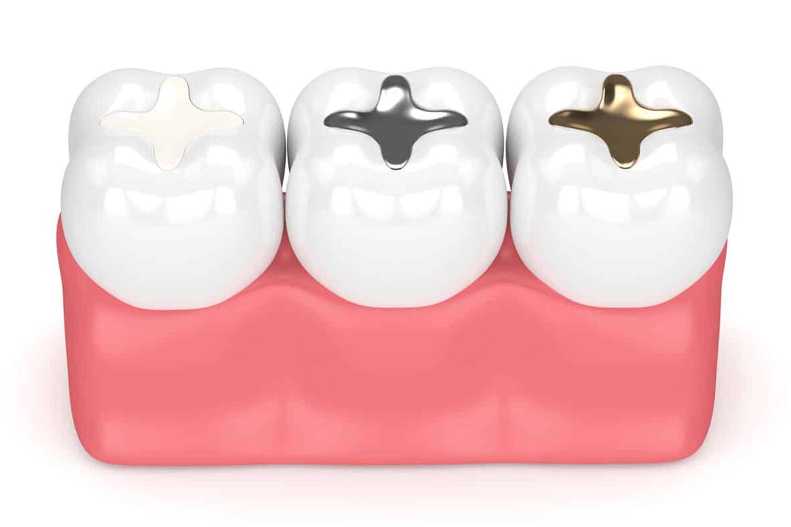 Tooth Colored Filling
